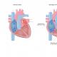 Hypertrofia pravej predsiene: príznaky choroby, hlavné príznaky a metódy liečby